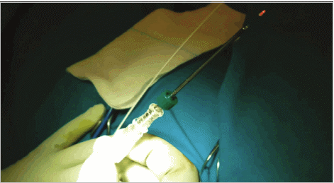 Σκιαδάς Παναγιώτης Γενικός Χειρουργός | Αιμορροϊδες με laser