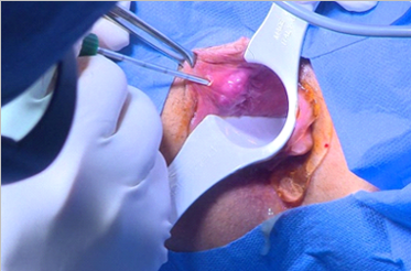 Σκιαδάς Παναγιώτης Γενικός Χειρουργός | Αιμορροϊδες με laser
